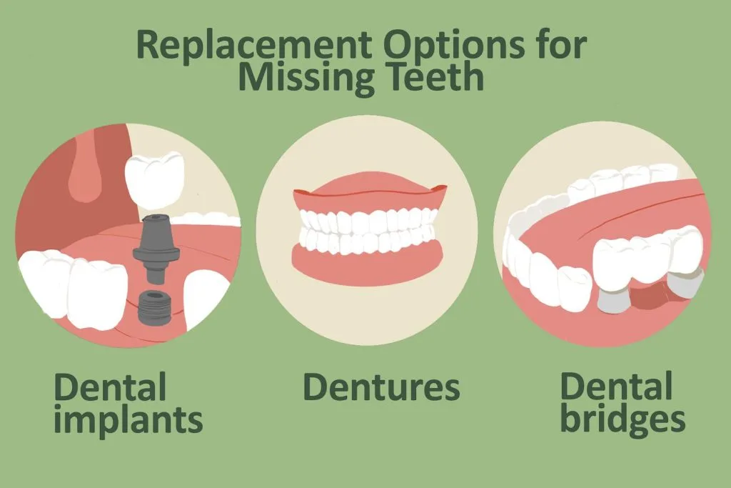 Replacement Options for Missing Tooth